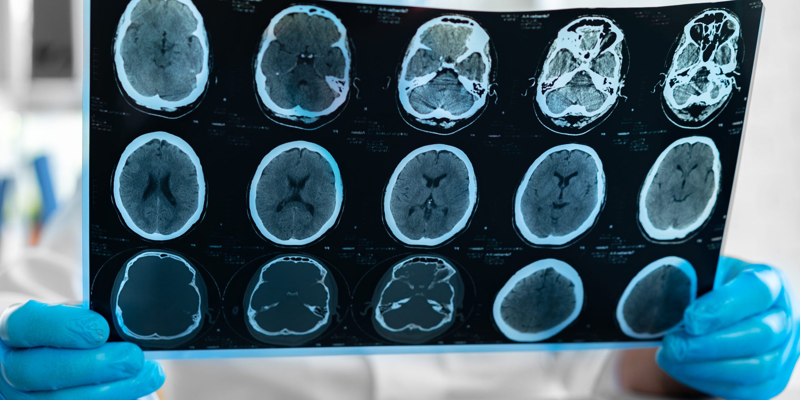 In Portugal, scientists found a new mechanism in the brain that may be the beginning of a method to repair neurons in the wake of brain damage.